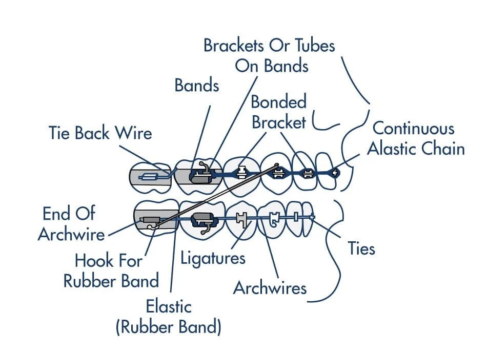 braces-diagram Image