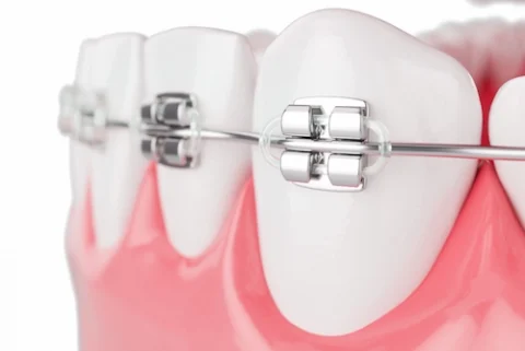 close-up-beauty-health-teeth-with-brace-selective-focus-3d-render