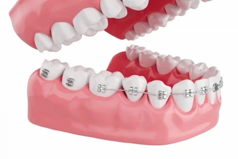 close-up-process-health-teeth-with-brace-selective-focus-3d-render (1)