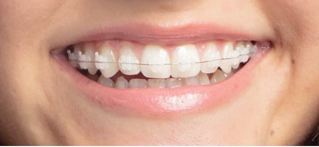 clear-braces-othman-orthodontics