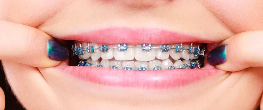 traditional-braces-othman-orthodontics