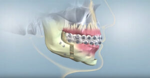 Illustration of orthognathic surgery procedure